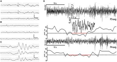 Electrophysiological Biomarkers of Epileptogenicity in Alzheimer’s Disease